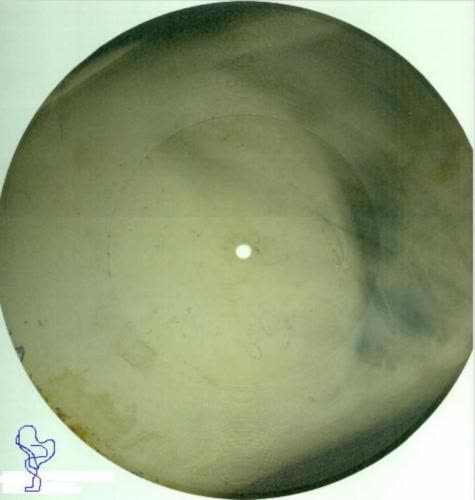 Een ribbenplaat: muziek gesneden in een oude röntgenfoto.
